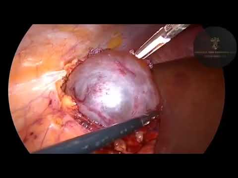 Лапароскопическое иссечение кисты почки